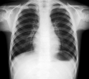 X-ray of lungs