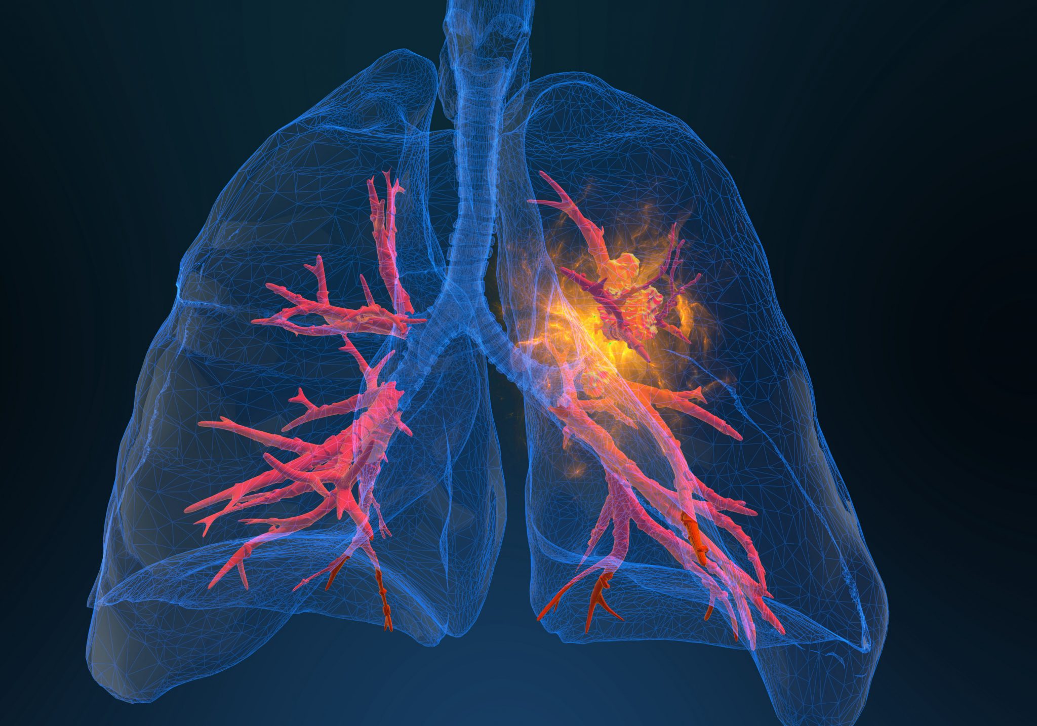 3d rendered illustration of lung cancer 3D illustration | Cancer Matters