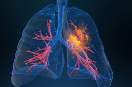 3d rendered illustration of lung cancer 3D illustration