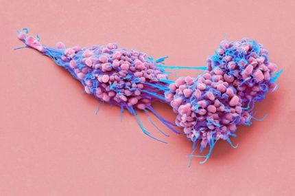 Ovarian cancer cells, sem Ovarian cancer cells, sem